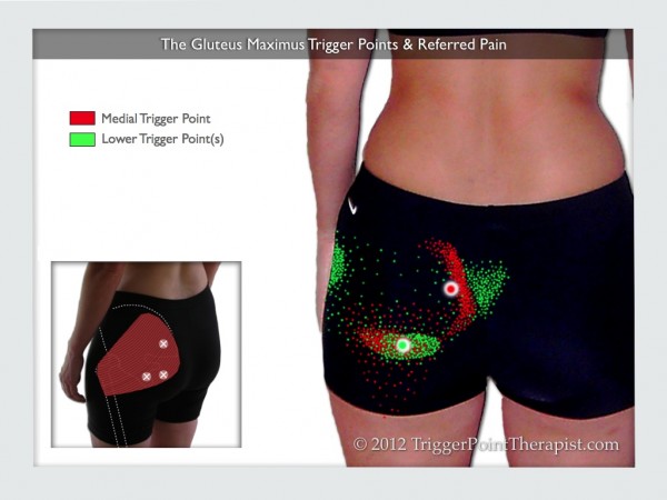 Gluteus Maximus Trigger Points: A Real Pain In The Rear End 