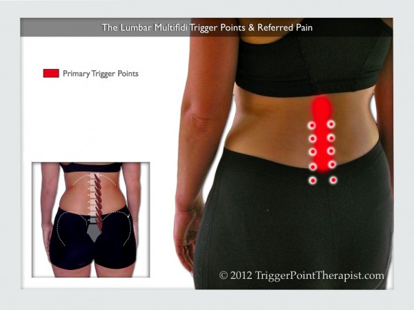 Multifidus Trigger Points The Chiropractors Nemesis