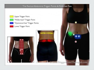 Rectus Abdominis Trigger Points: A Six-pack Of Deception 