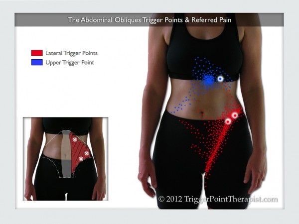 Abdominal Oblique Trigger Points: South Of The Border Pain 