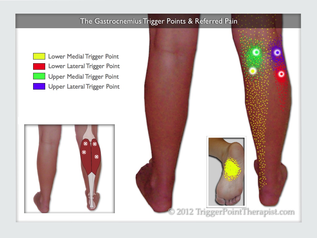 Gastrocnemius Trigger Points The Calf Cramp Trigger Points