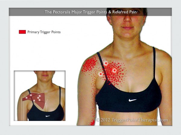 pectoralis-major-trigger-points-the-cardiac-copycats