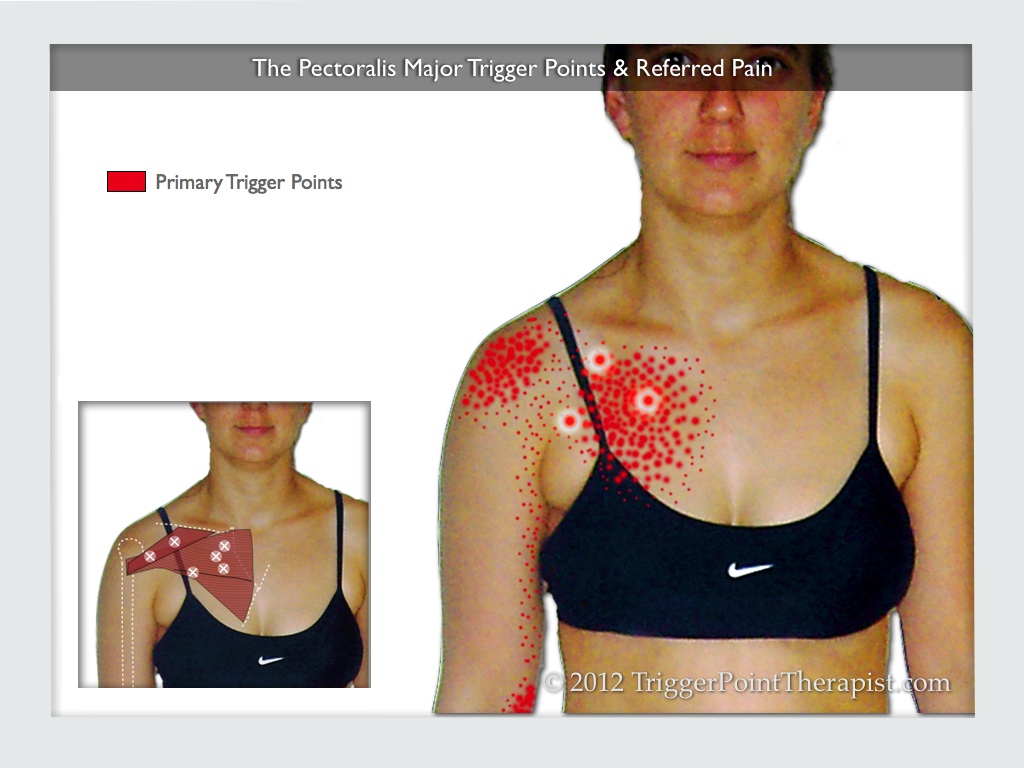 Pectoralis Major Trigger Points The Cardiac Copycats 