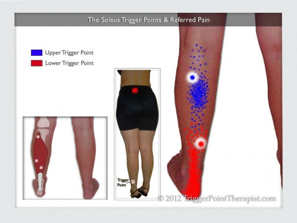 Soleus Trigger Points And Heel Pain 