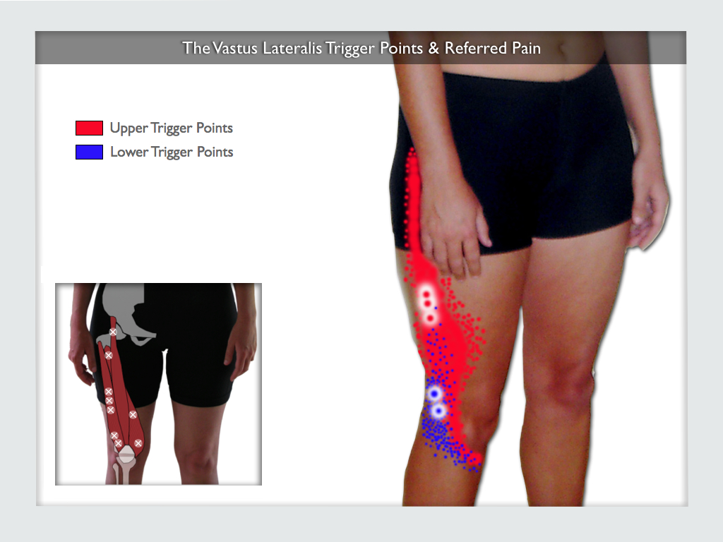 Vastus Lateralis Trigger Points The Knee Pain Trigger Points Part 1