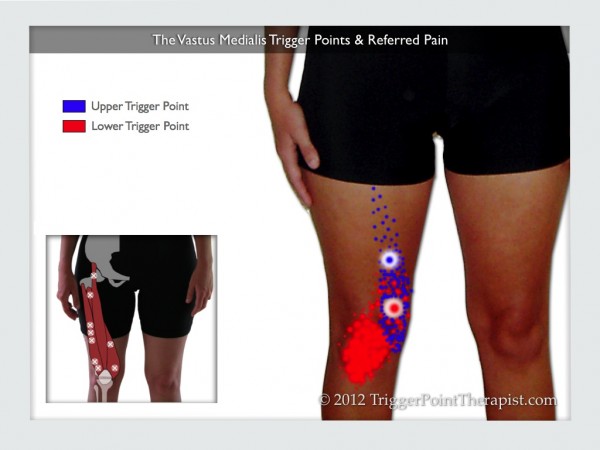 Vastus Medialis Trigger Points: The Knee Pain Trigger Points - Part 3 