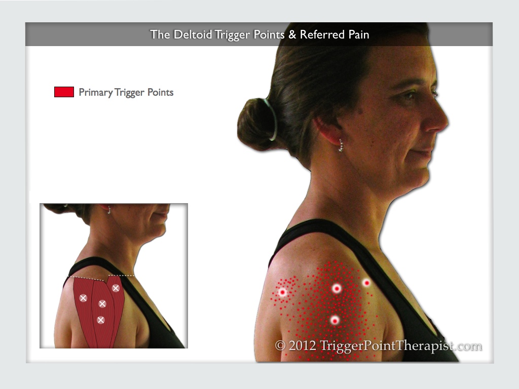 Deltoid Trigger Points What You See Is What You Get