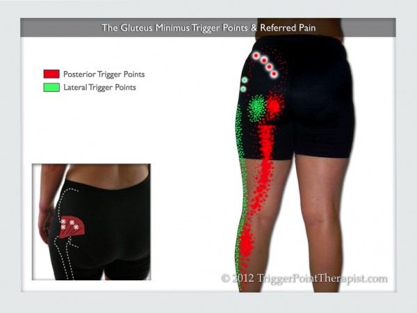 Gluteus Minimus Trigger Points: Small Muscle...Big Mouth ...