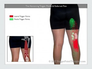 The Hamstring Trigger Points: Hiding in Plain Sight ...