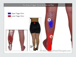 Soleus Trigger Points and Heel Pain | TriggerPointTherapist.com