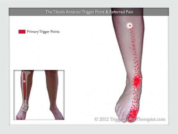 Tibilais Anterior Trigger Point: The Foot Drop Trigger Point ...